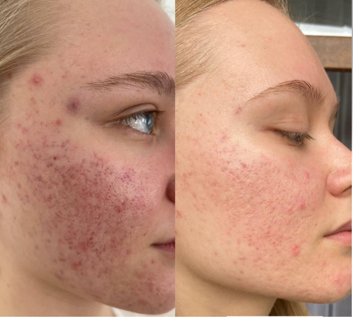 Piel con acné activo — antes / después