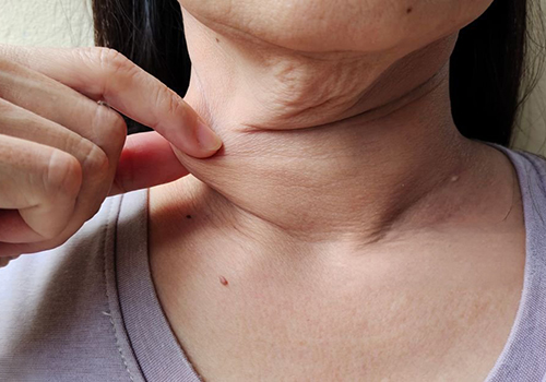 Bioestimuladores de Colágeno