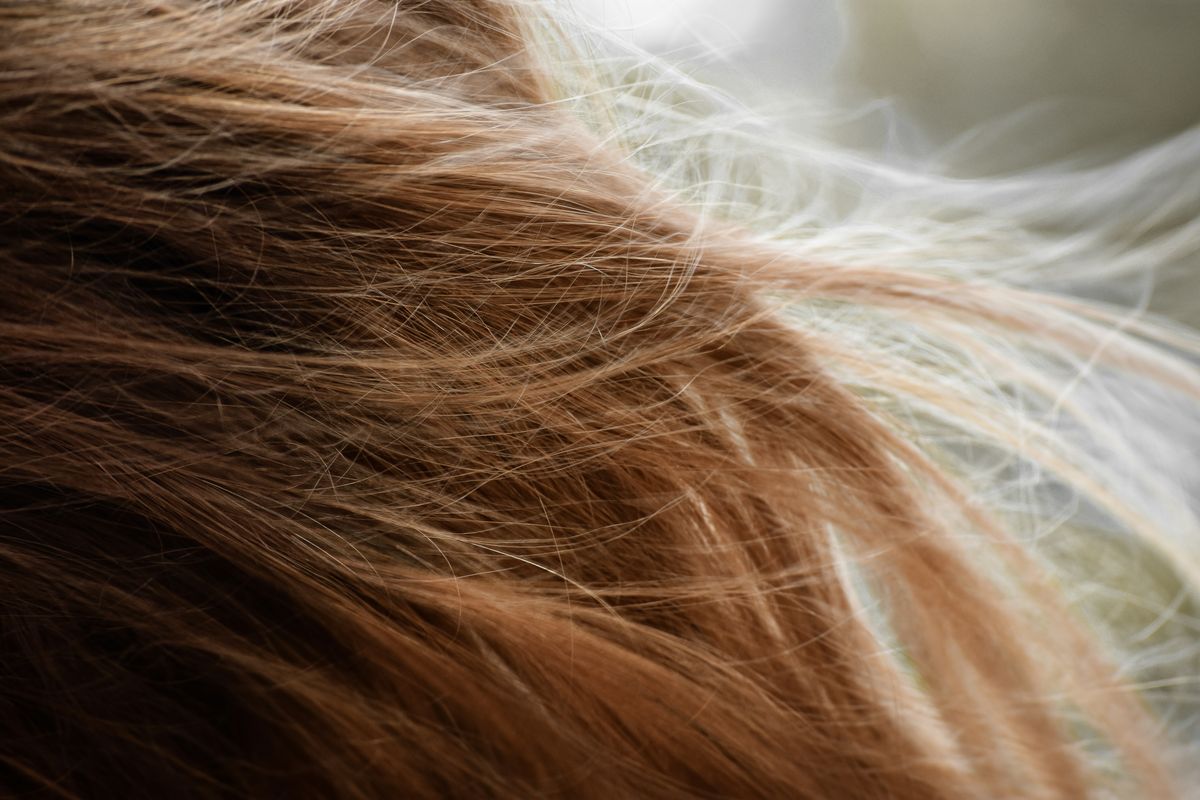 Alopecia androgenética